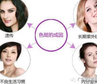 我们脸上为什么会长斑呢？激光祛斑到底靠不靠谱？